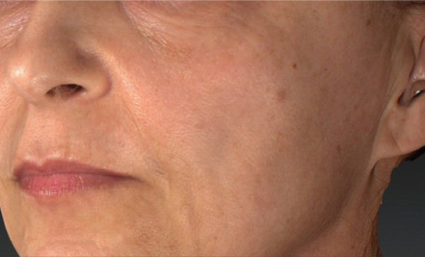 Laser Skin Rejuvenation - Before