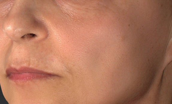 Laser Skin Rejuvenation - After